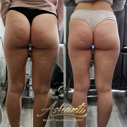 Ashanti Beauty Salon & Academy #beograd Tretmani tela Ultrazvučna kavitacija + vakum sa bipolarnim 