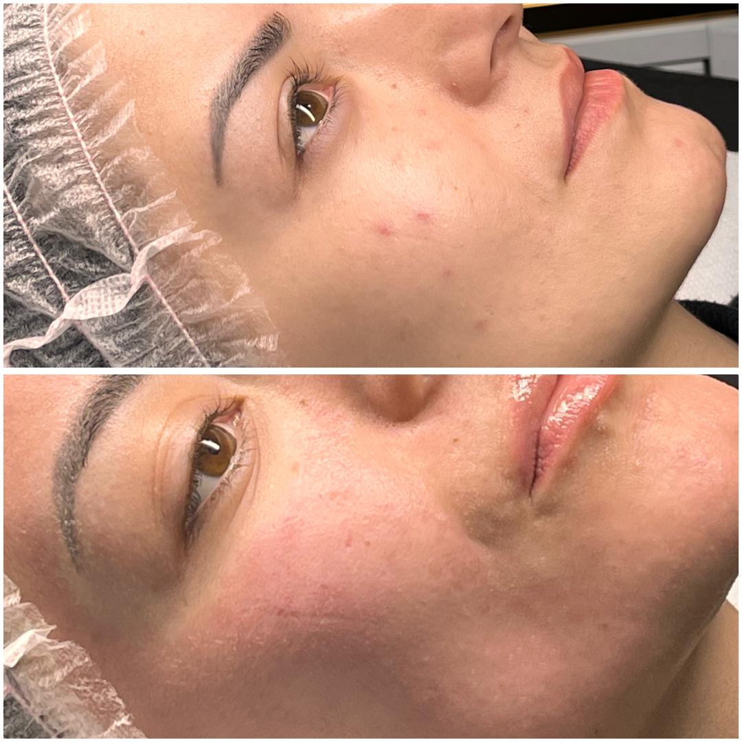 Belle Ana #beograd Tretman lica Microneedling tretman - lice