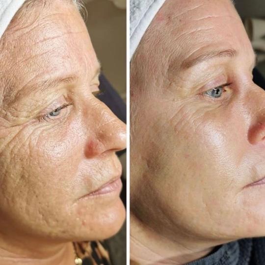 Beauty Glam House #nis Tretmani protiv bora Hifu tretman - lice HIFU (High Intensity Focused Ultraso