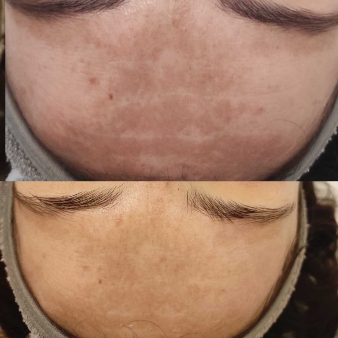 Olja Beauty #beograd Tretman lica Hemijsko uklanjanje melazme