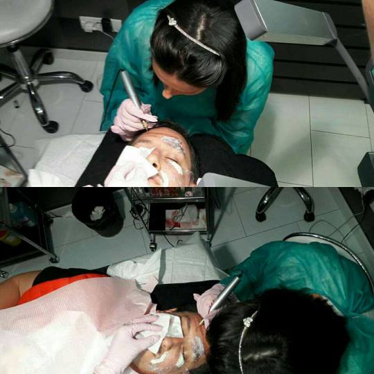 Maximus 1 #nis Tretmani protiv bora Korekcija bora Fibroblast metoda - za korekciju kapaka i dubokih