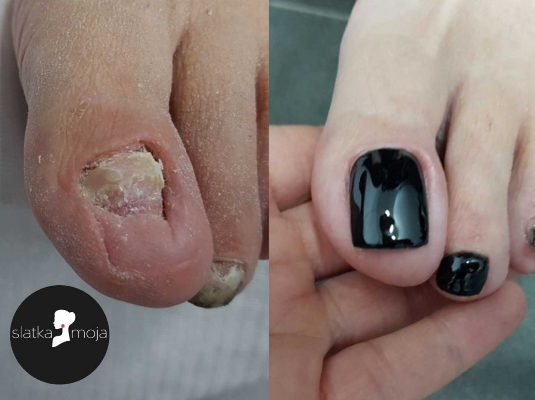 Slatka moja #beograd Medicinski pedikir Medicinski pedikir + proteza + gel lak