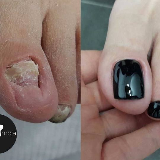 Slatka moja #beograd Medicinski pedikir Medicinski pedikir + proteza + gel lak