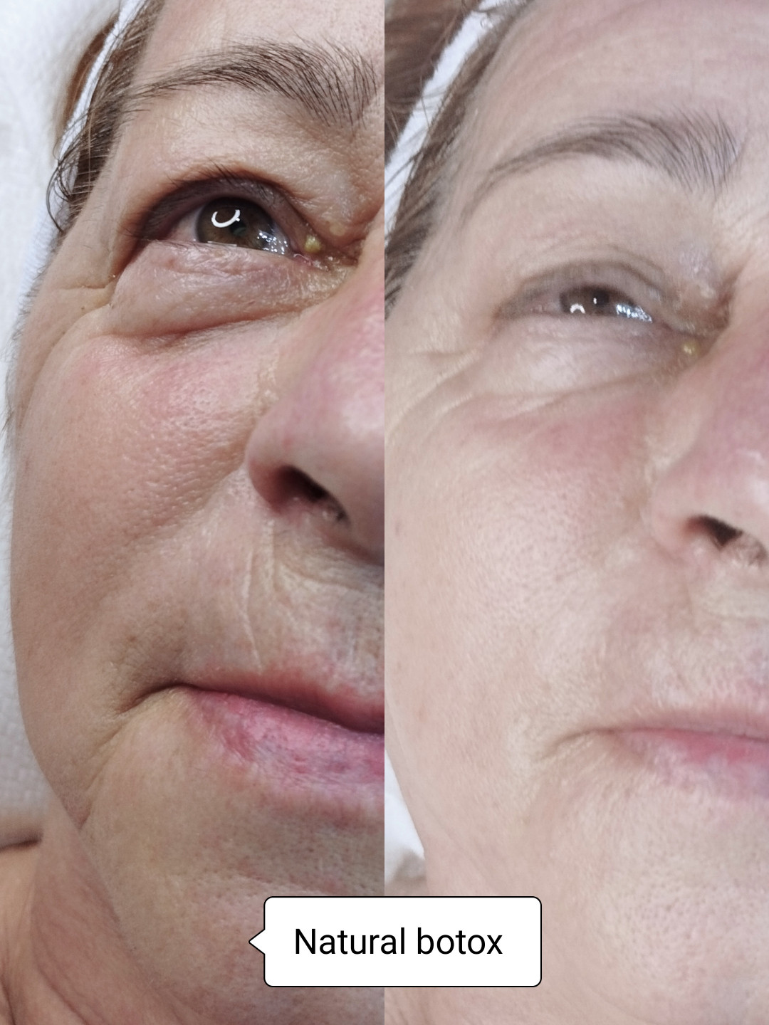 Contessa #novisad Tretman lica Natural botox