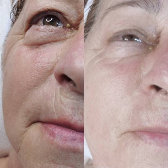 Contessa #novisad Tretman lica Natural botox