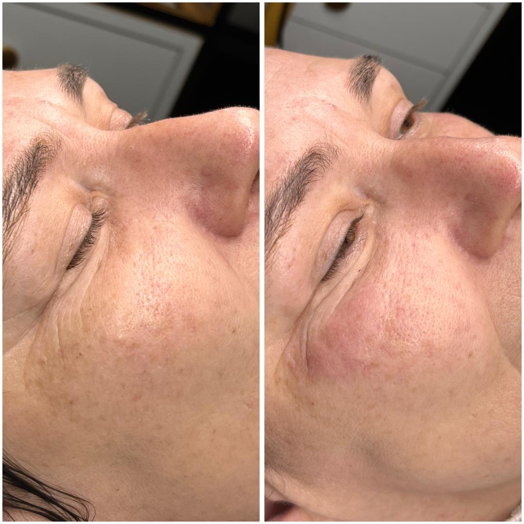 Belle Ana #beograd Tretman lica Microneedling tretman - lice