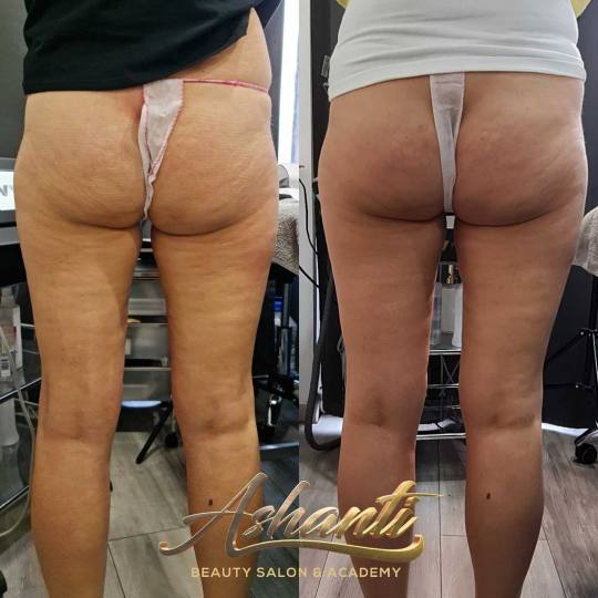Ashanti Beauty Salon & Academy #beograd Radiotalasni i ultrazvučni tretmani Radiotalasni lifting - 
