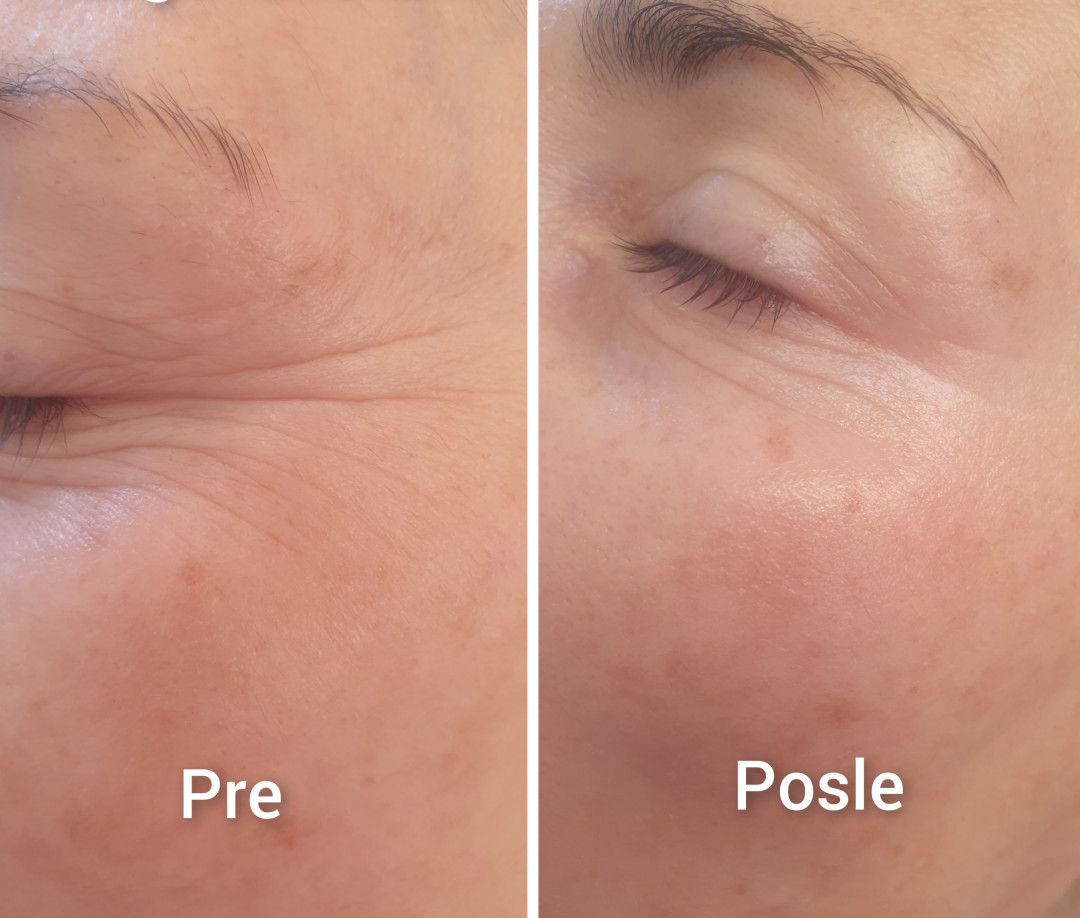 Pro Beauty Team #beograd Tretman lica Kolagenske niti - po regiji