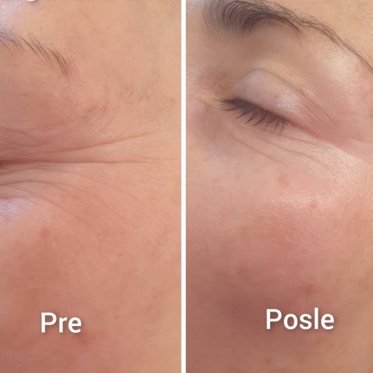 Pro Beauty Team #beograd Tretman lica Kolagenske niti - po regiji