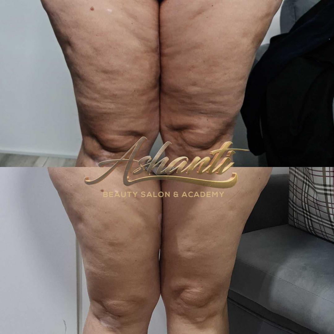Ashanti Beauty Salon & Academy #beograd Kavitacija Ultrazvučna kavitacija noge - paket od 5 tretmana