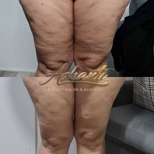 Ashanti Beauty Salon & Academy #beograd Kavitacija Ultrazvučna kavitacija noge - paket od 5 tretman
