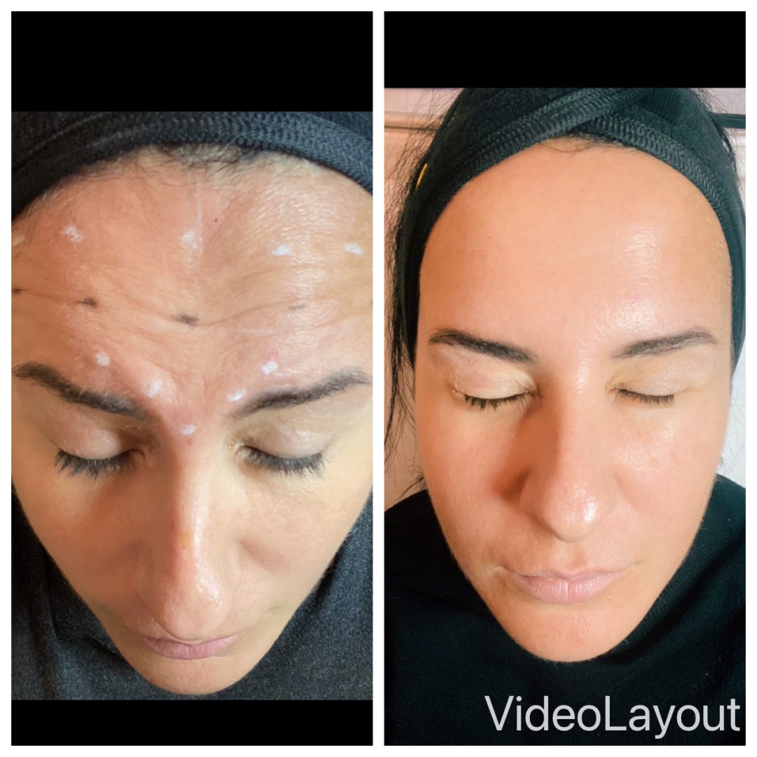 Apolona #beograd Botox Botox - 3 regije