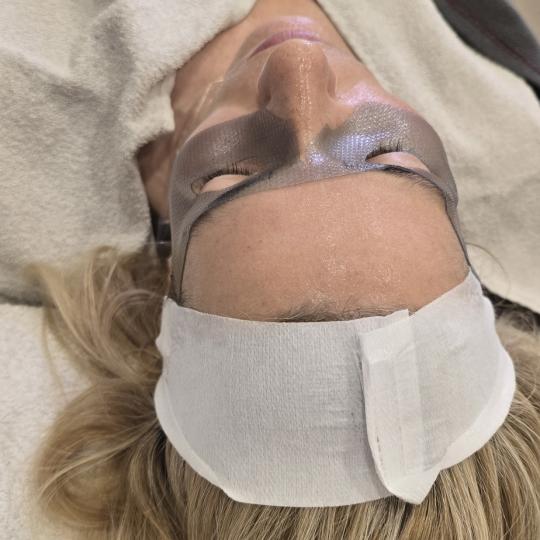 Laser lab by Ceca #novisad Tretman lica Dermapen + mezoterpija mikroiglicama - paket od tri tretmana