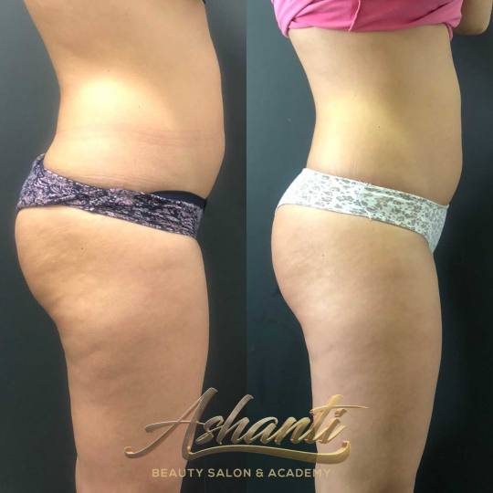 Ashanti Beauty Salon & Academy #beograd Tretmani tela Ice Body Sculpting