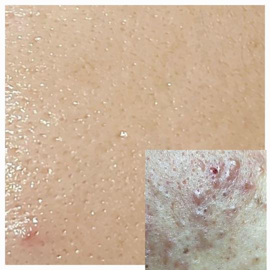 Bella Lunika Estetic studio #pancevo Tretman lica Fitopiling terapija lica Fitopiling je i dalje ne 