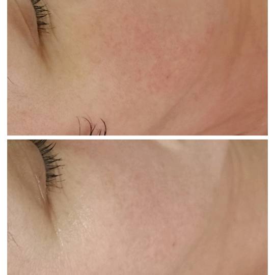 Bloom #sremska-mitrovica Tretman lica Happy skin (hidratacija i umirenje reaktivne i osetljive kože