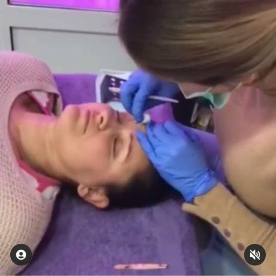 AltaBella Batajnica #beograd Laserski tretmani lica Lasersko podmlađivanje lica