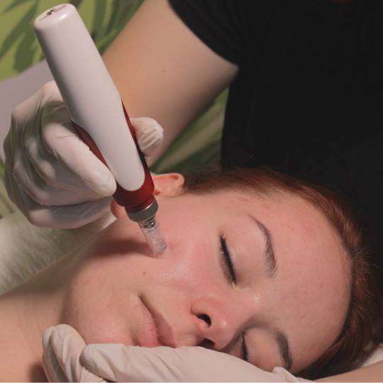 Orient #beograd Dermaroler i dermapen Dermapen