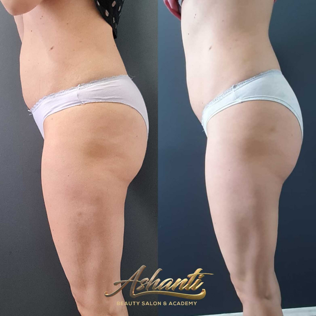 Ashanti Beauty Salon & Academy #beograd Masaža za mršavljenje Dermapen - regija lica