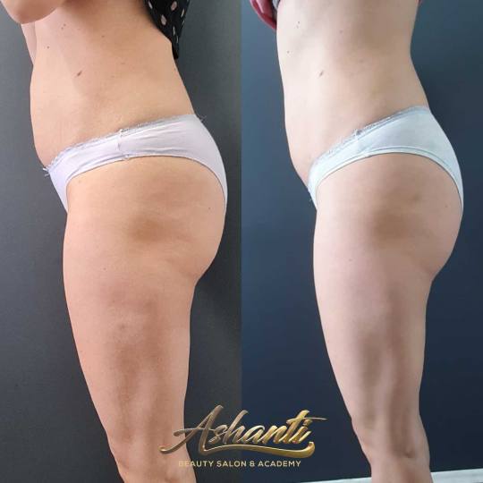 Ashanti Beauty Salon & Academy #beograd Masaža za mršavljenje Dermapen - regija lica
