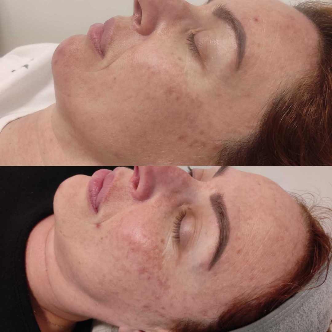 Olja Beauty #beograd Mezoterapija lica Mezoterapija + hemijski piling