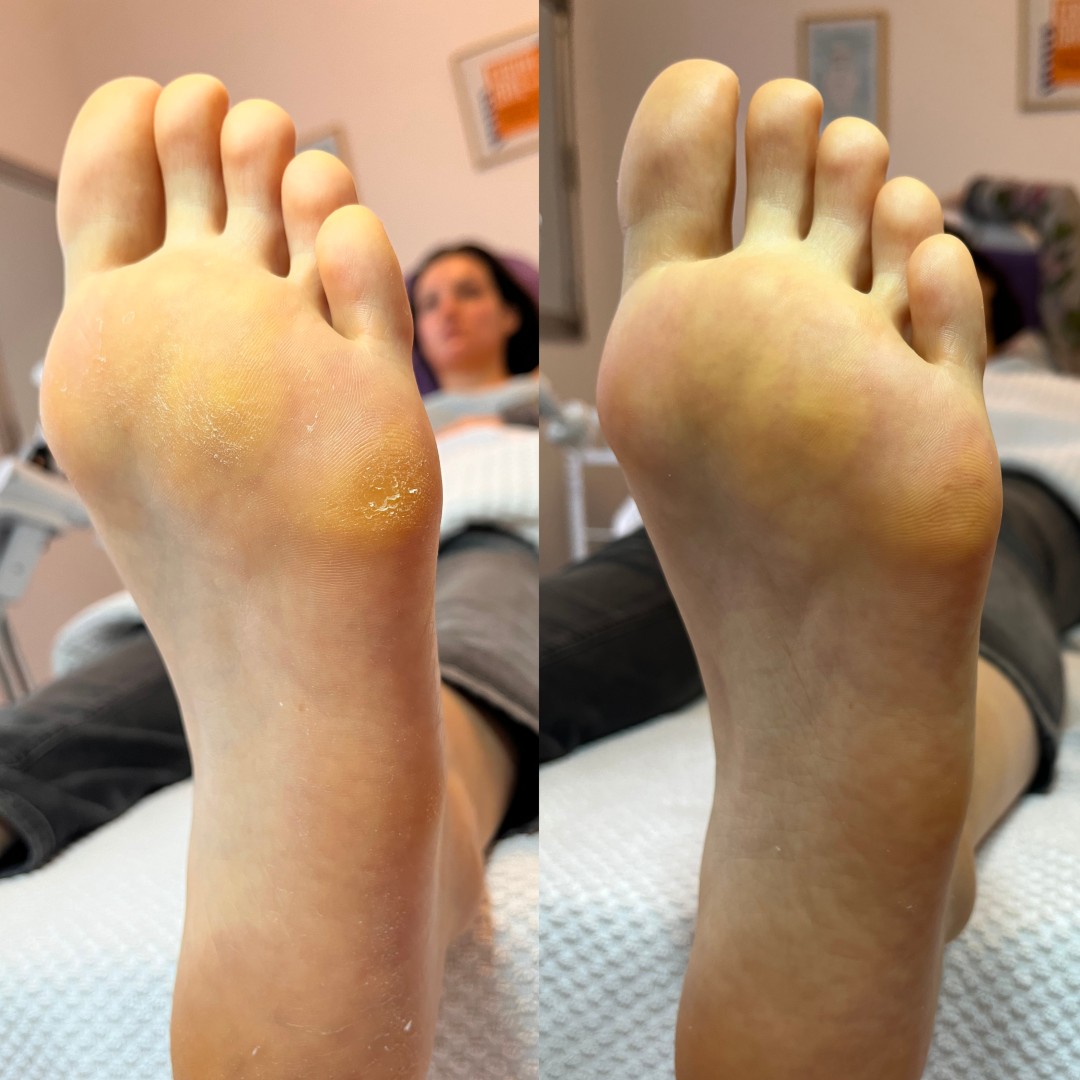 Beauty Derma MKK #beograd Estetski pedikir Estetski pedikir
