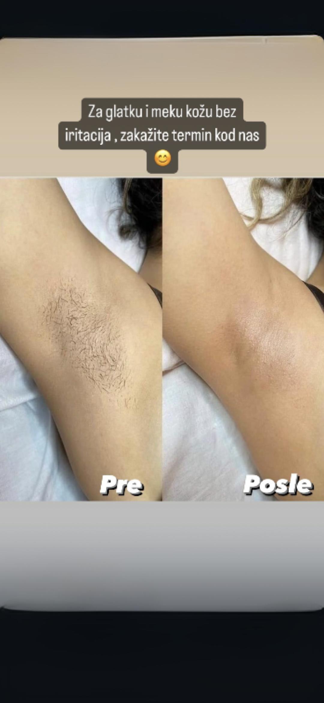 Afro Spa #beograd Depilacija šećernom pastom Depilacija pazuha šećernom pastom - za dame