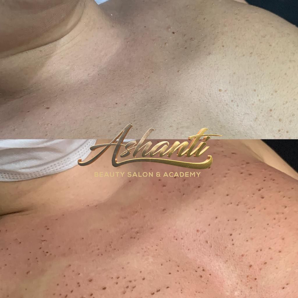 Uklanjanje virusnih bradavica - Ashanti Beauty Salon & Academy, Beograd Tretman lica Lice Tretman lica, Beograd, Voždovac