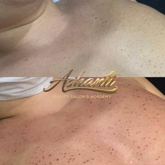 Ashanti Beauty Salon & Academy #beograd Tretman lica Uklanjanje virusnih bradavica