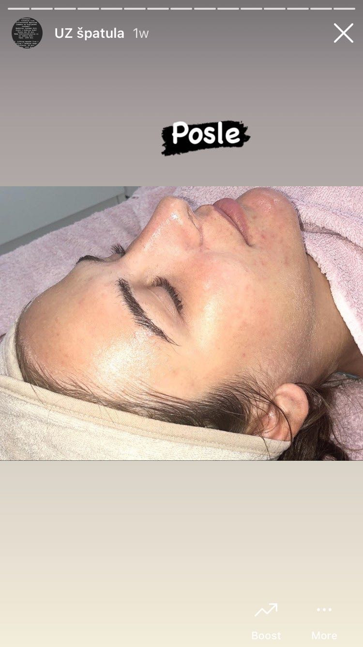 Čišćenje lica ultrazvučnom špatulom - Makeup Olja Grbić, Novi Sad Tretman lica Lice Tretman lica, Novi Sad, Rotkvarija, Podbara, Salajka