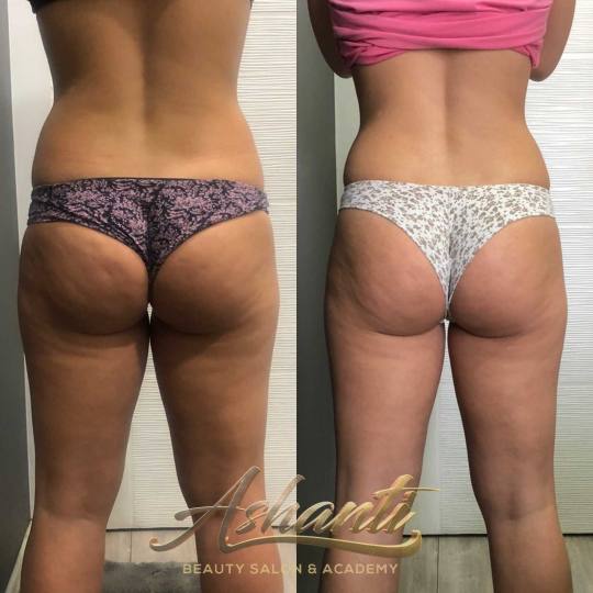 Ashanti Beauty Salon & Academy #beograd Tretmani tela Ice Body Sculpting