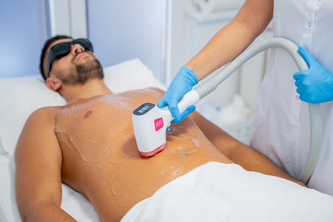 Monika Barta Cosmetics #novisad Laserska epilacija Laserska epilacija stomaka + grudi + leđa + pazuha - za muškarce
