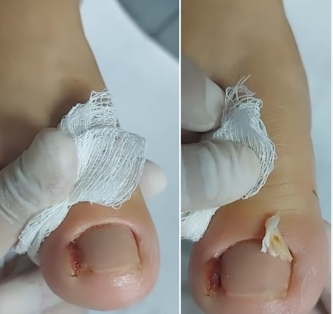 Bellavana studio #krusevac Medicinski pedikir Medicinski pedikir - više problematičan