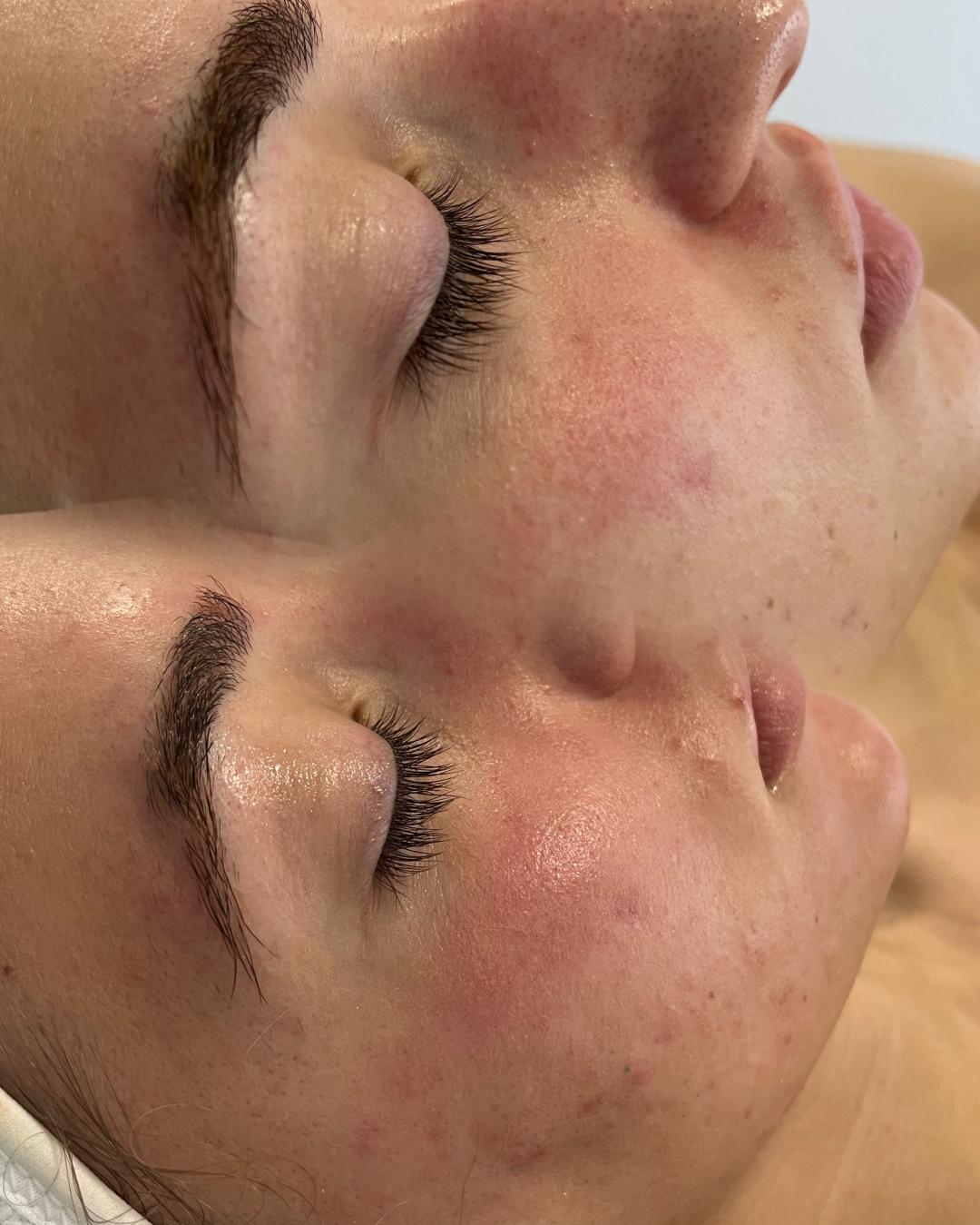 Higijenski tretman lica - lux hydra - Bella Lunika Estetic studio, Pančevo Tretman lica Lice Tretman lica, Pančevo, Centar