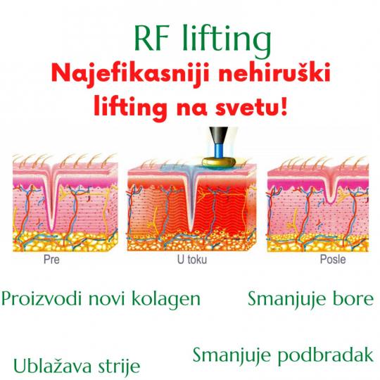 Viva Derm #beograd Radiotalasni i ultrazvučni tretmani RF lifting - lice + vrat + dekolte