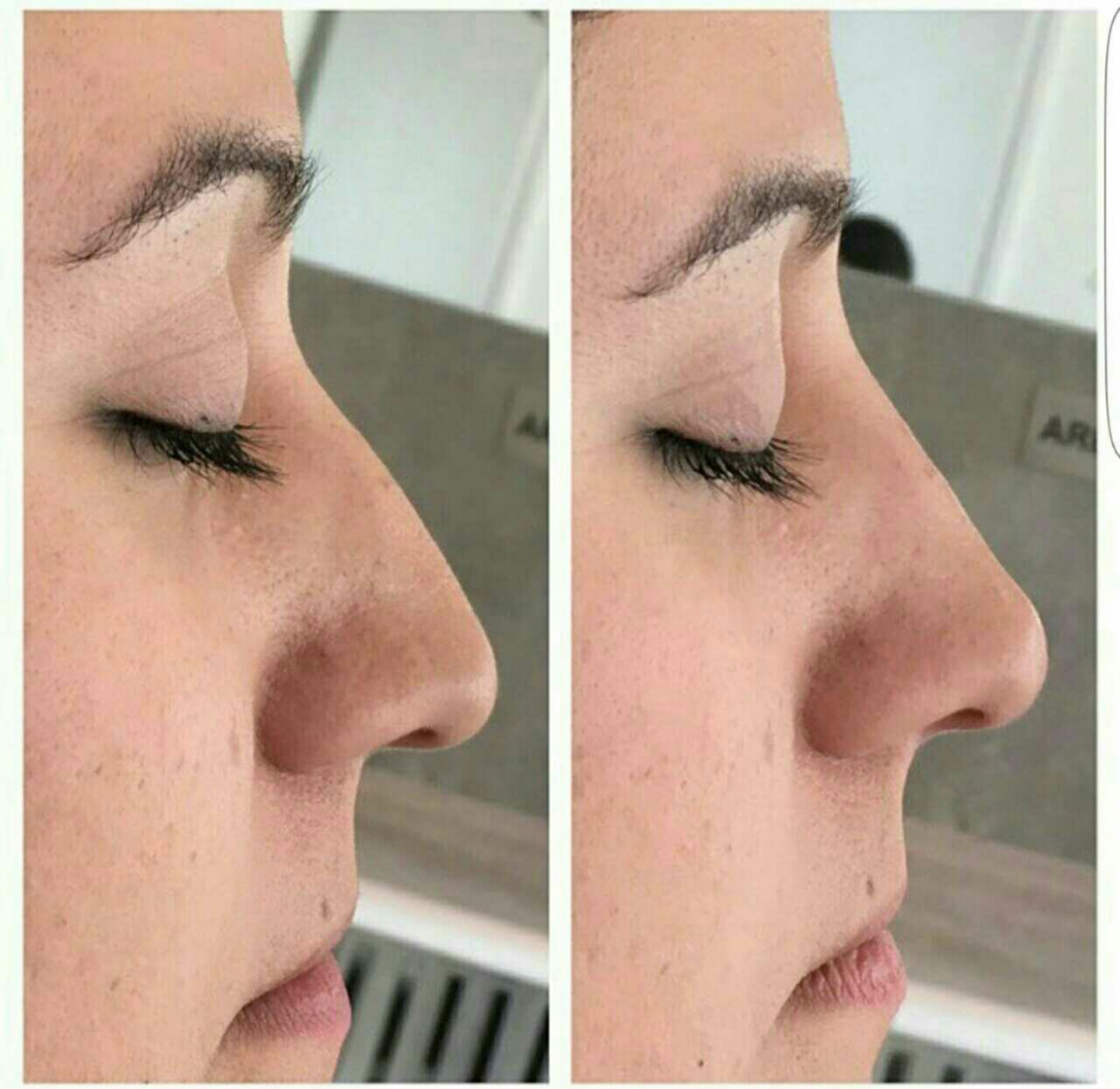 Centar Renew #beograd Dermalni fileri Hijaluronski fileri - 1ml