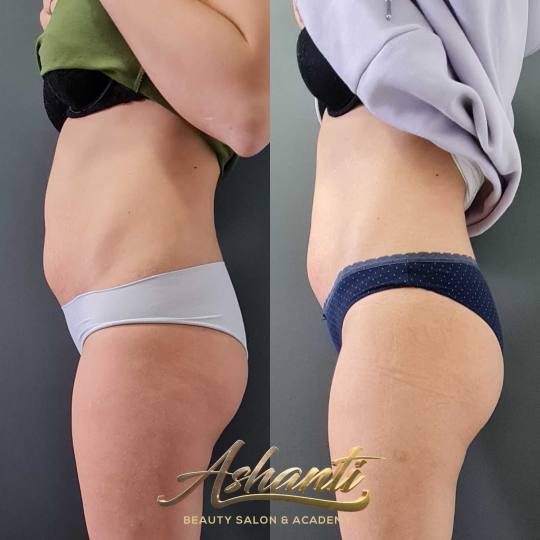 Ashanti Beauty Salon & Academy #beograd Radiotalasni i ultrazvučni tretmani Radiotalasni lifting - 