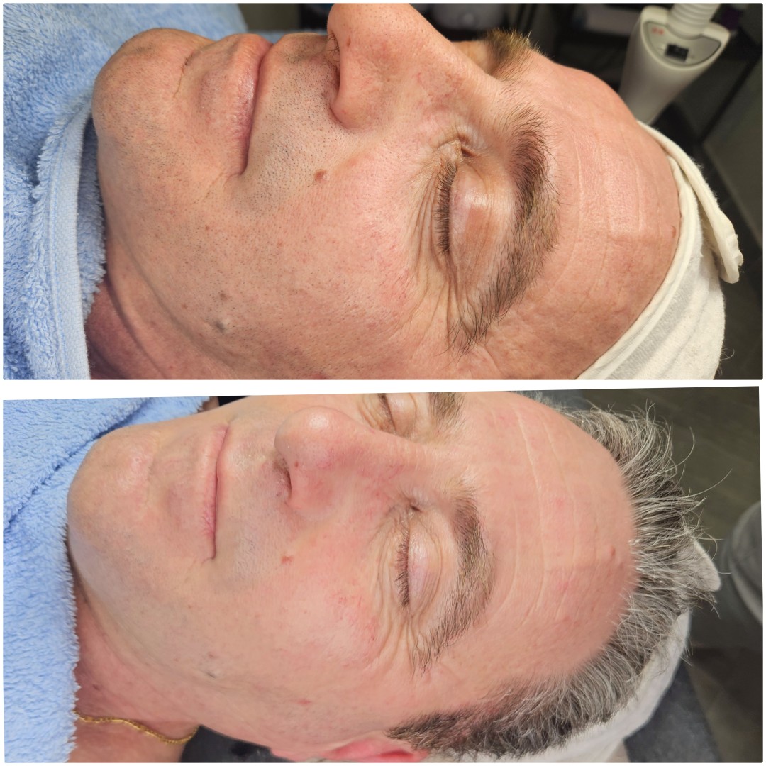 Beauty salon XL Lady #beograd Tretman lica Enzimski piling Retinol Kick - polu tretman