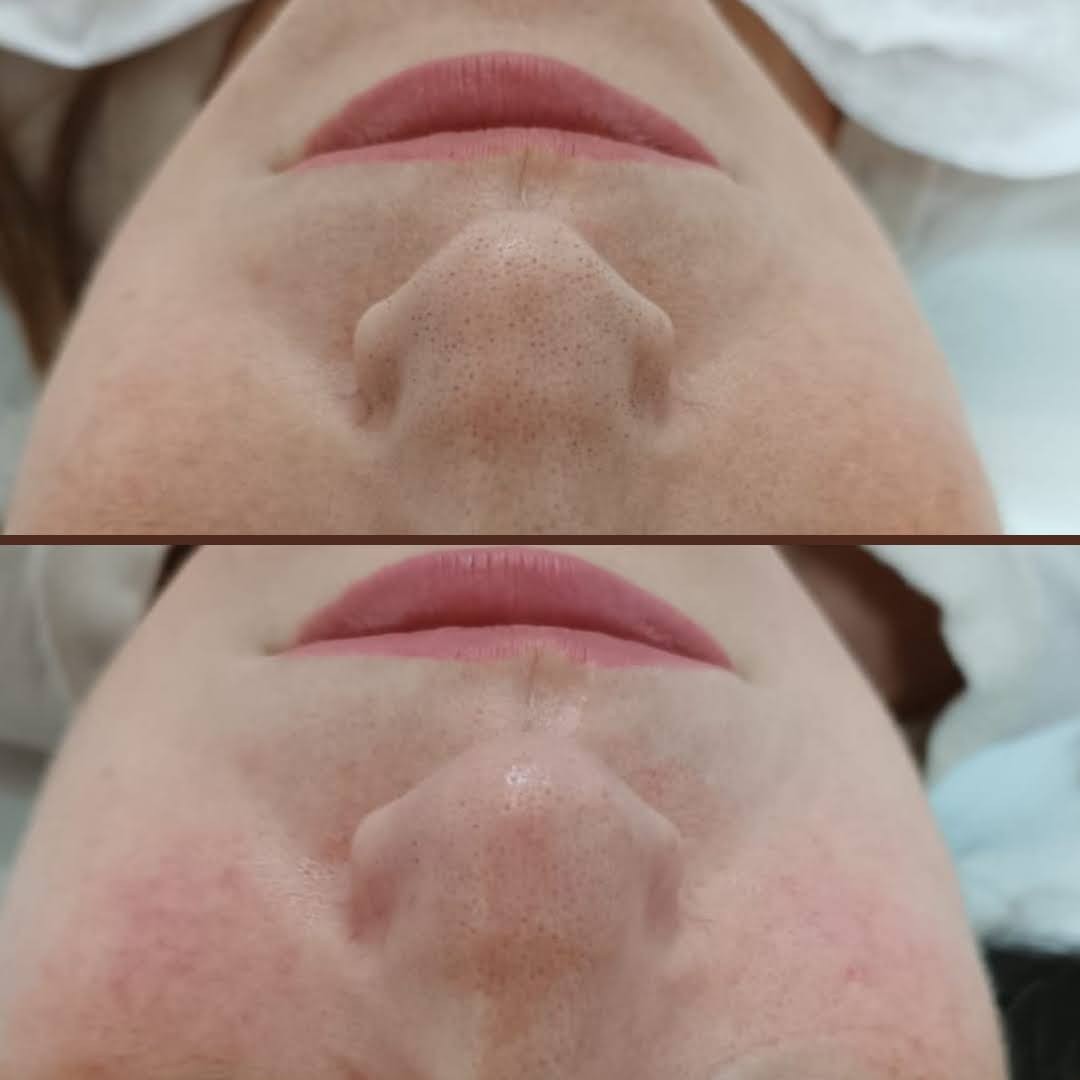 MediBella Aesthetic Dedinje #beograd Tretman lica