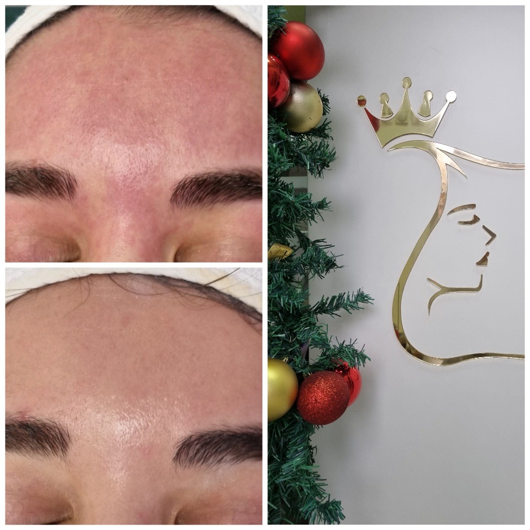 Emilly #beograd Anticelulit masaža Hydra Advanced Ericson