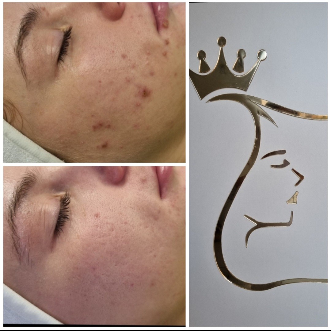 Emilly #beograd Tretman lica Higijenski tretman lica + mikrodermoabrazija