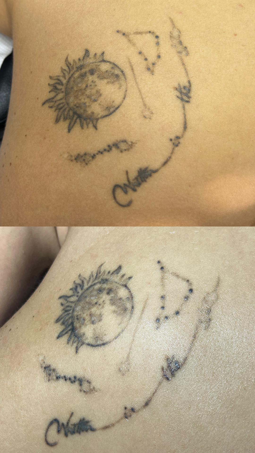 Belle Ana #beograd Uklanjanje tetovaža Lasersko uklanjanje tetovaže