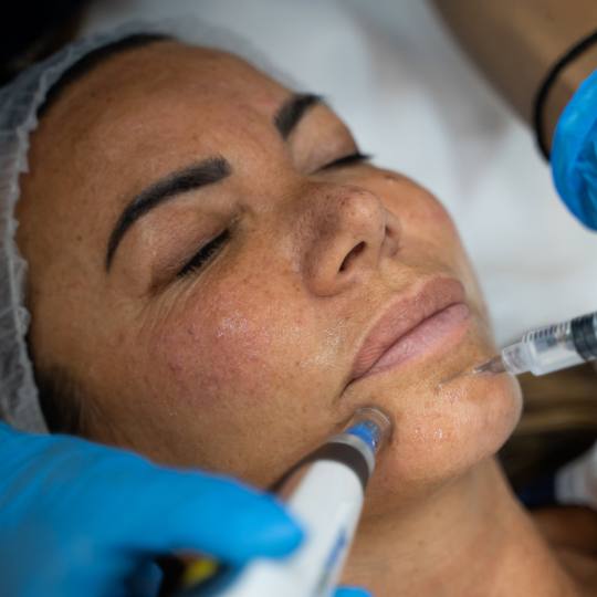 MediBella Aesthetic Dedinje #beograd Dermaroler i dermapen Dermapen 4 tretman + mezokokteli - lice