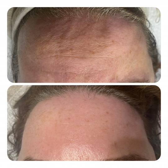 Prestige #beograd Tretman lica Biorevitalizacija lica Biorevitalizacija predstavlja jedan od najinov