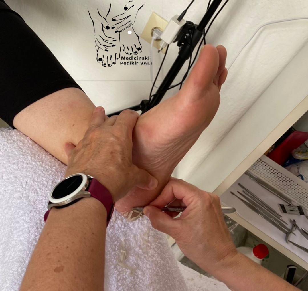 Vali&Nađa #novisad Medicinski pedikir