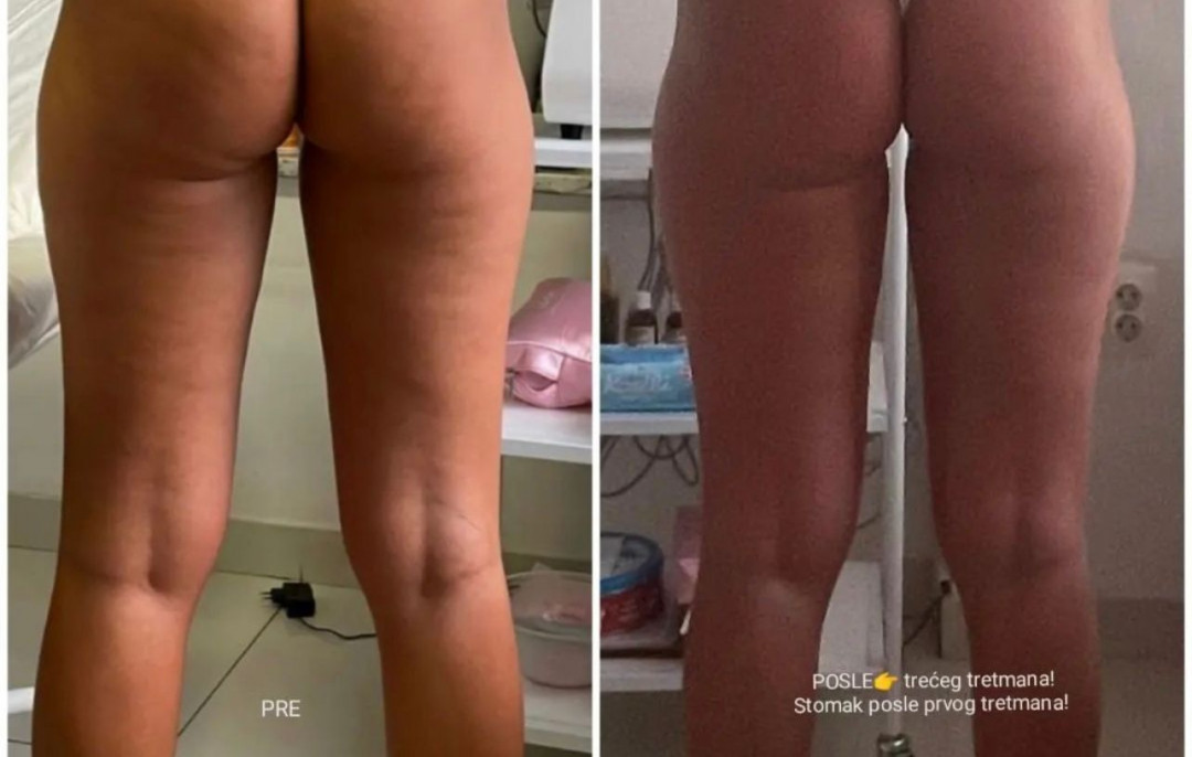 Lipolaser Centar - Matrix021 #novisad Tretmani tela