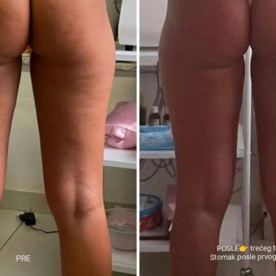 Lipolaser Centar - Matrix021 #novisad Tretmani tela Lipo-Lux paket je posebno osmišljen za savršen