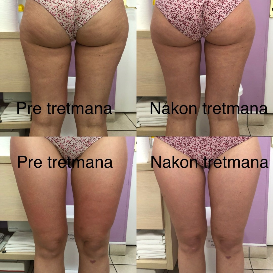 Poliklinika Marić #novisad Mezoterapija tela Mezoterapija celulita sa iglicama