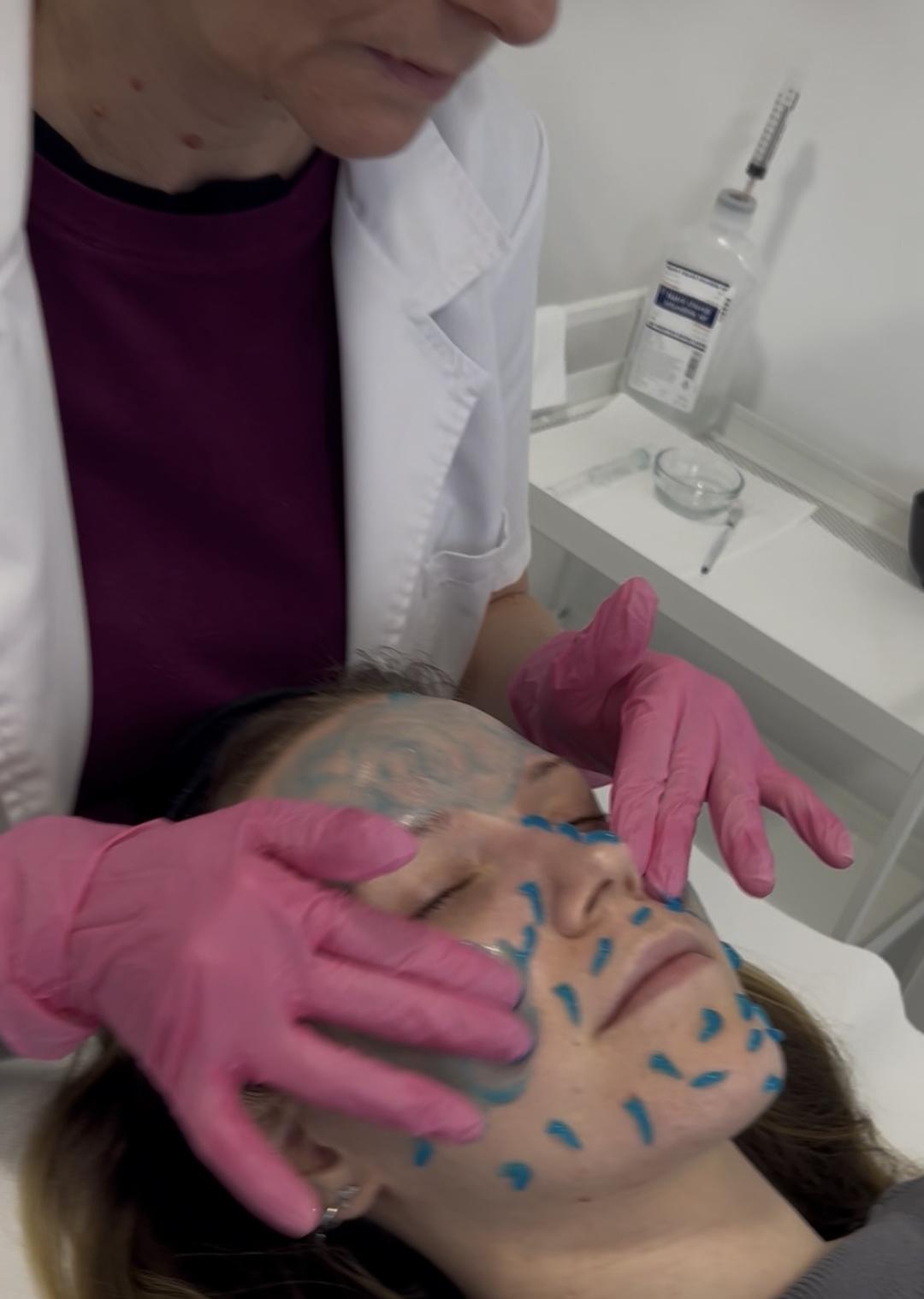 Sandra estetik studio #beograd Tretman lica Liquid spicule