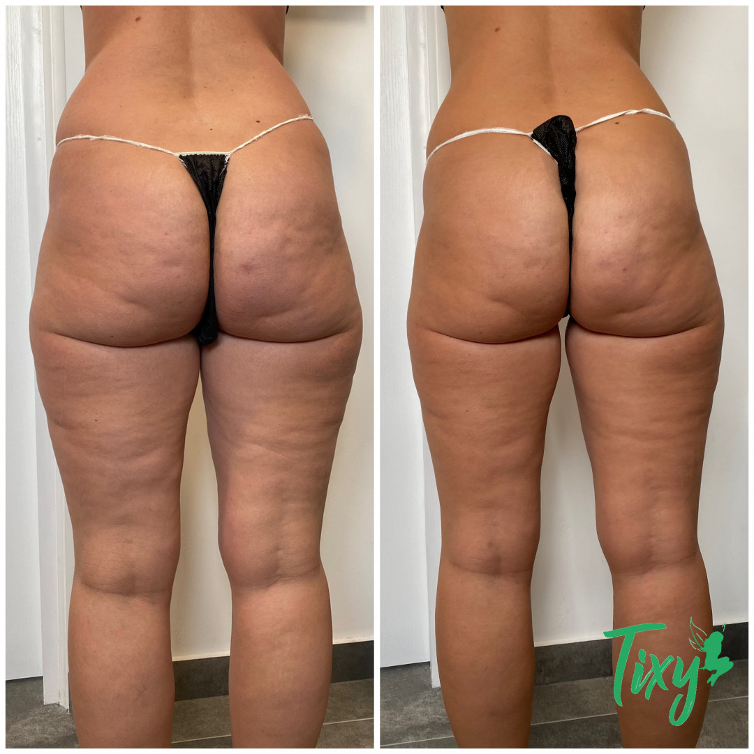 Tixy - Veternik #novisad Lifting / zatezanje kože Lipo ultrazvučna kavitacija + IR butine + gluteus + stomak + ruke